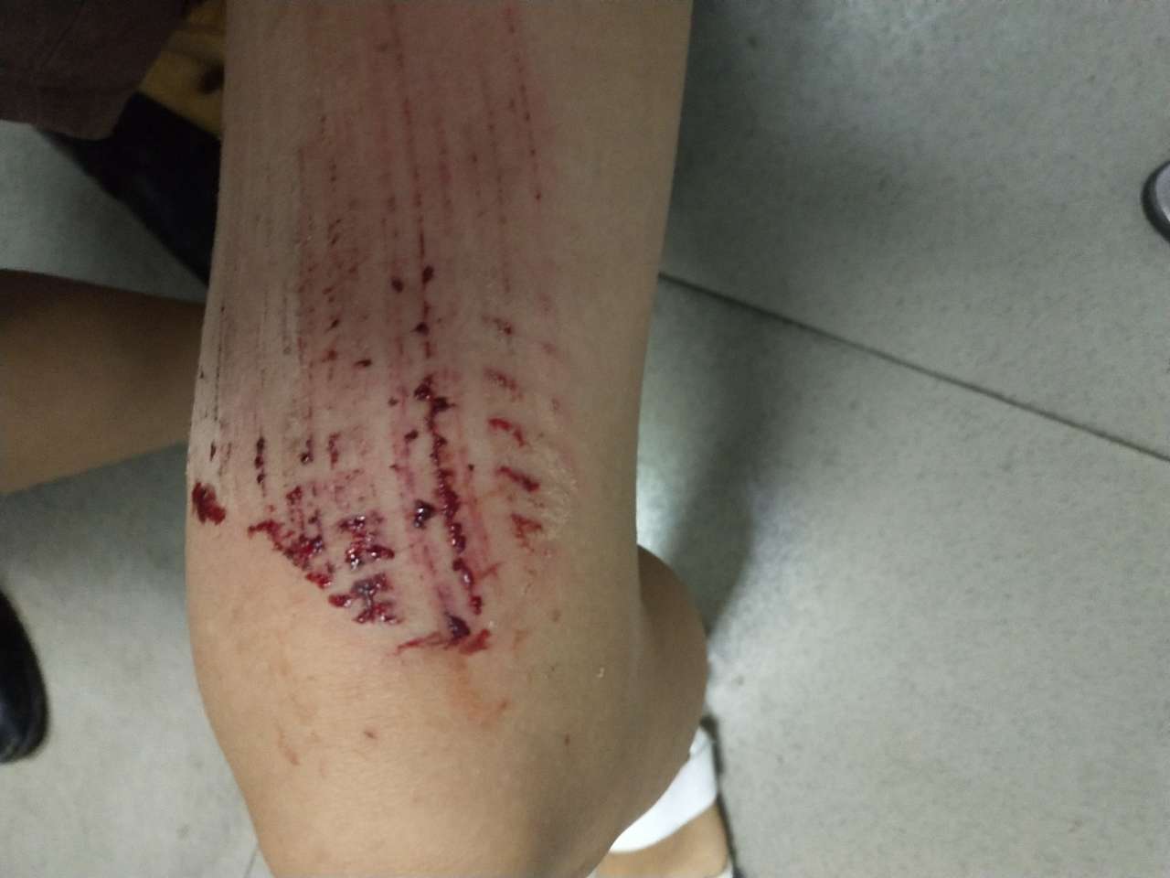 宜宾遇到"吃"人井盖,女儿大腿很受伤,希望相关部门能够主动出面解决!