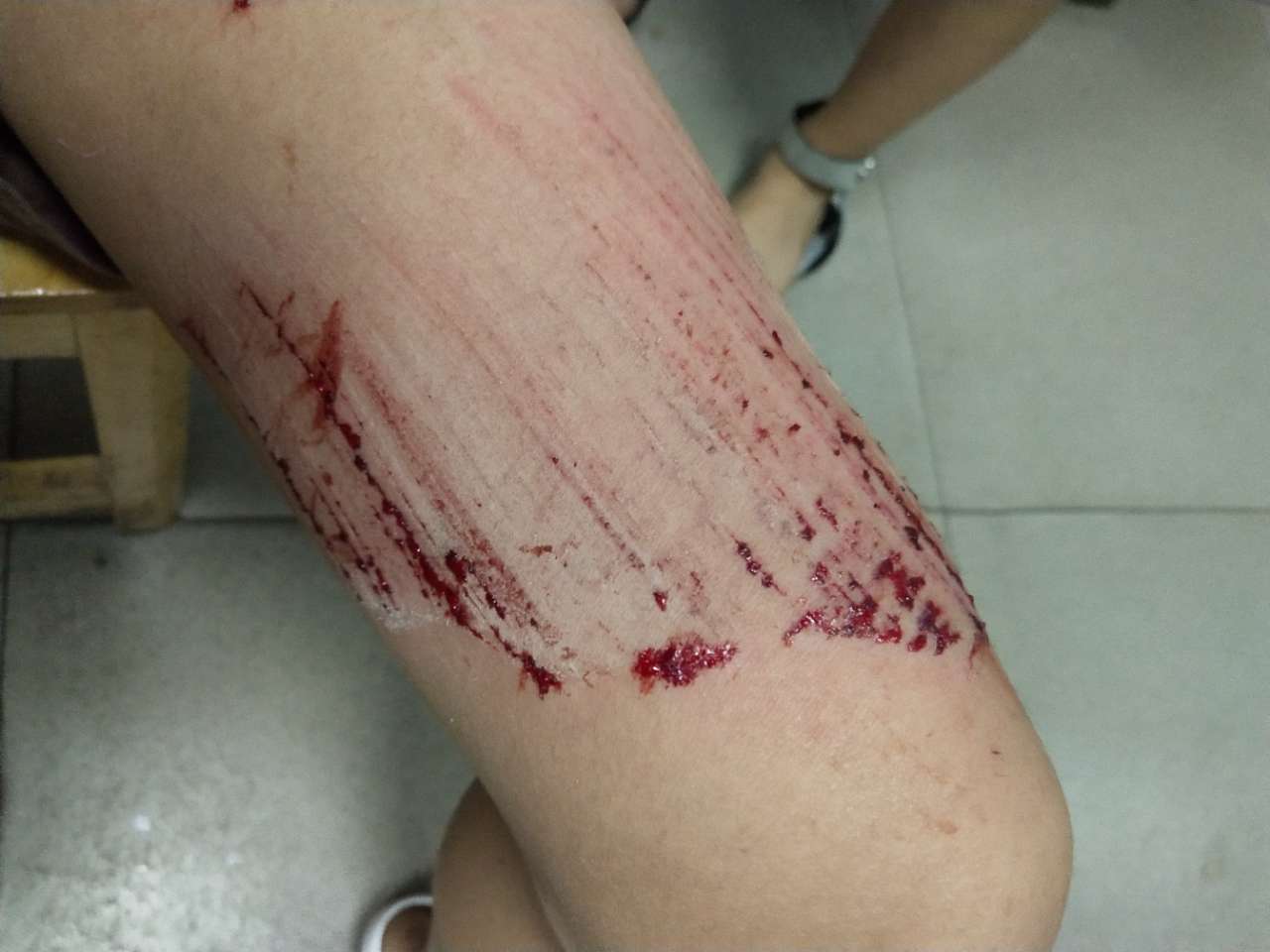 宜宾遇到吃人井盖女儿大腿很受伤希望相关部门能够主动出面解决