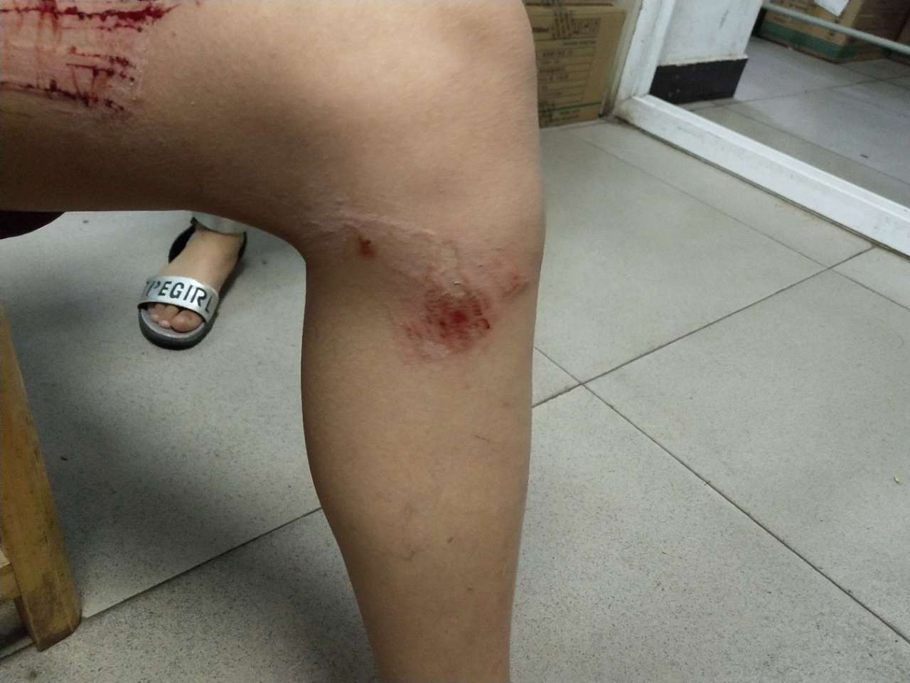 宜宾遇到"吃"人井盖,女儿大腿很受伤,希望相关部门能够主动出面解决!