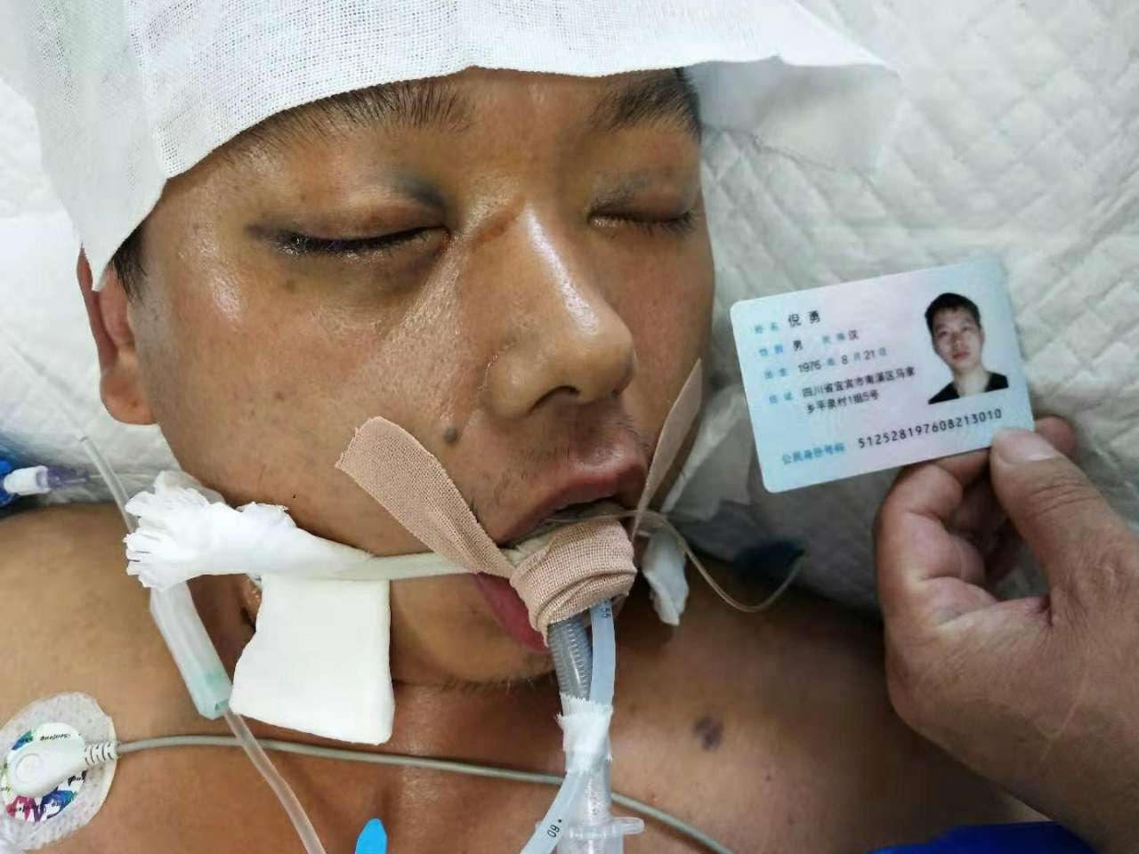 筹款救命43岁家里顶梁柱热射病重度昏迷